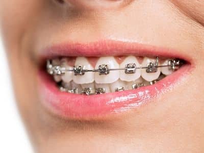 Are Braces Worth It? Essential Facts Before You Decide