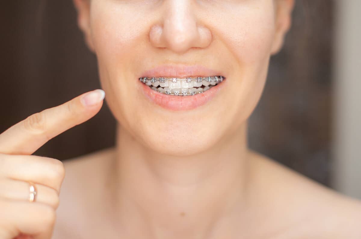 Metal Braces vs. Transparent Braces: Which One is Better?
