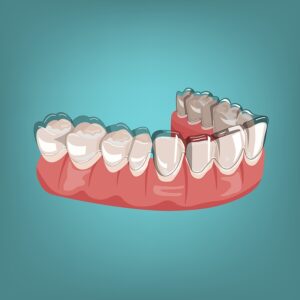 How Long Does Invisalign Take To Work? Timeline &Amp; More