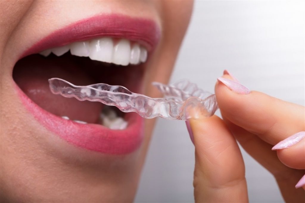 How Long Does Invisalign Take To Work? Timeline &Amp; More