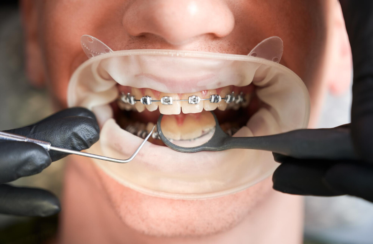 Tips For Braces Wearers: 10 Ways To Boost Comfort &Amp; Speed